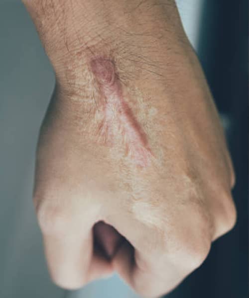 Queloides y cicatrices hipertróficas: tratamientos naturales